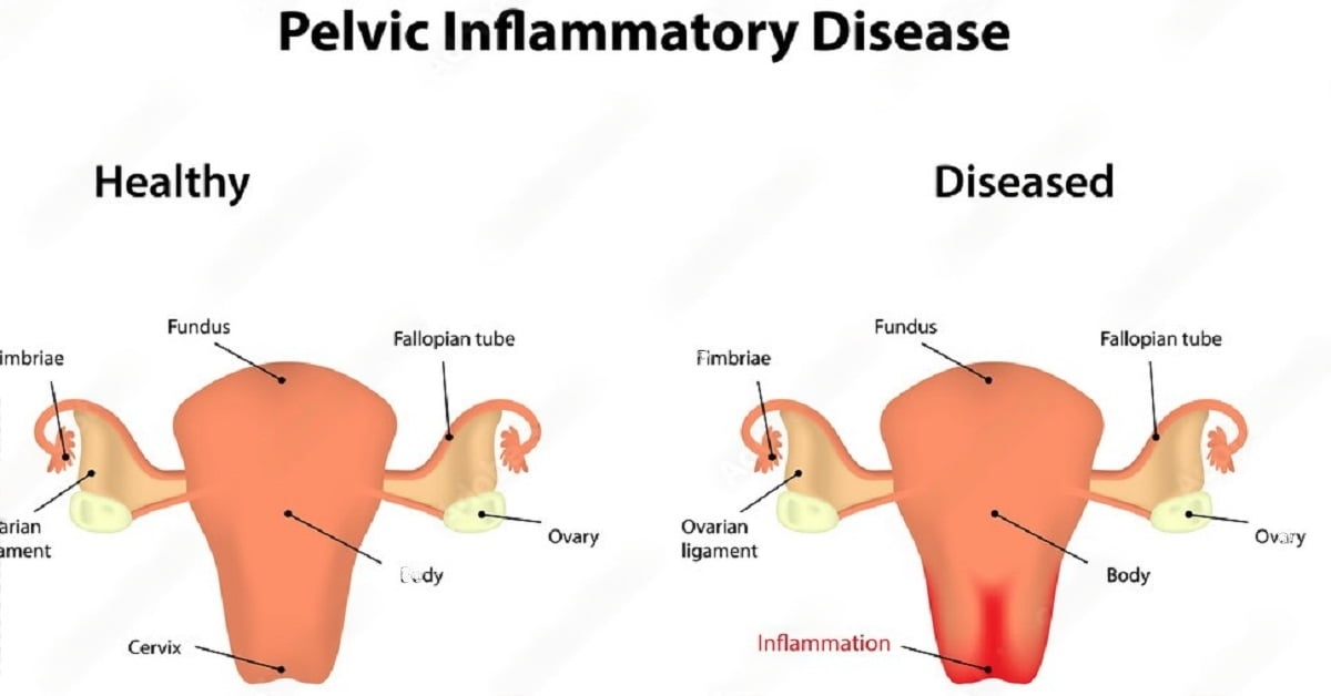 Pelvic Inflammatory Disease Dr. Rubeena Zainab