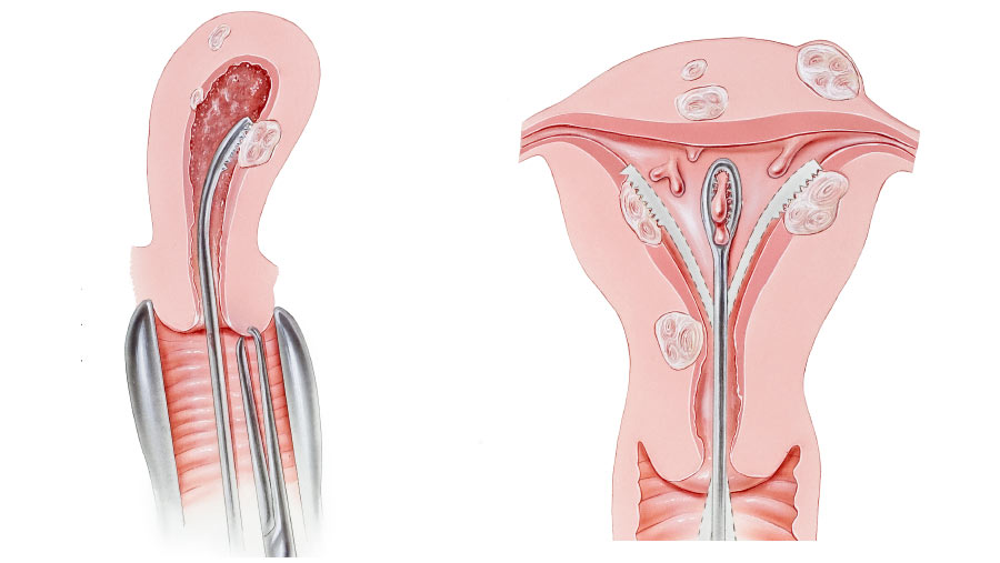 Septal-Resection