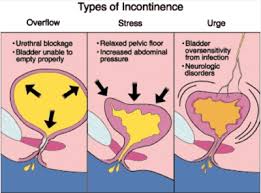 Urinary incontinence